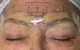 Old brow tattoo healed grey and uneven, before correction by Kate Kanner
